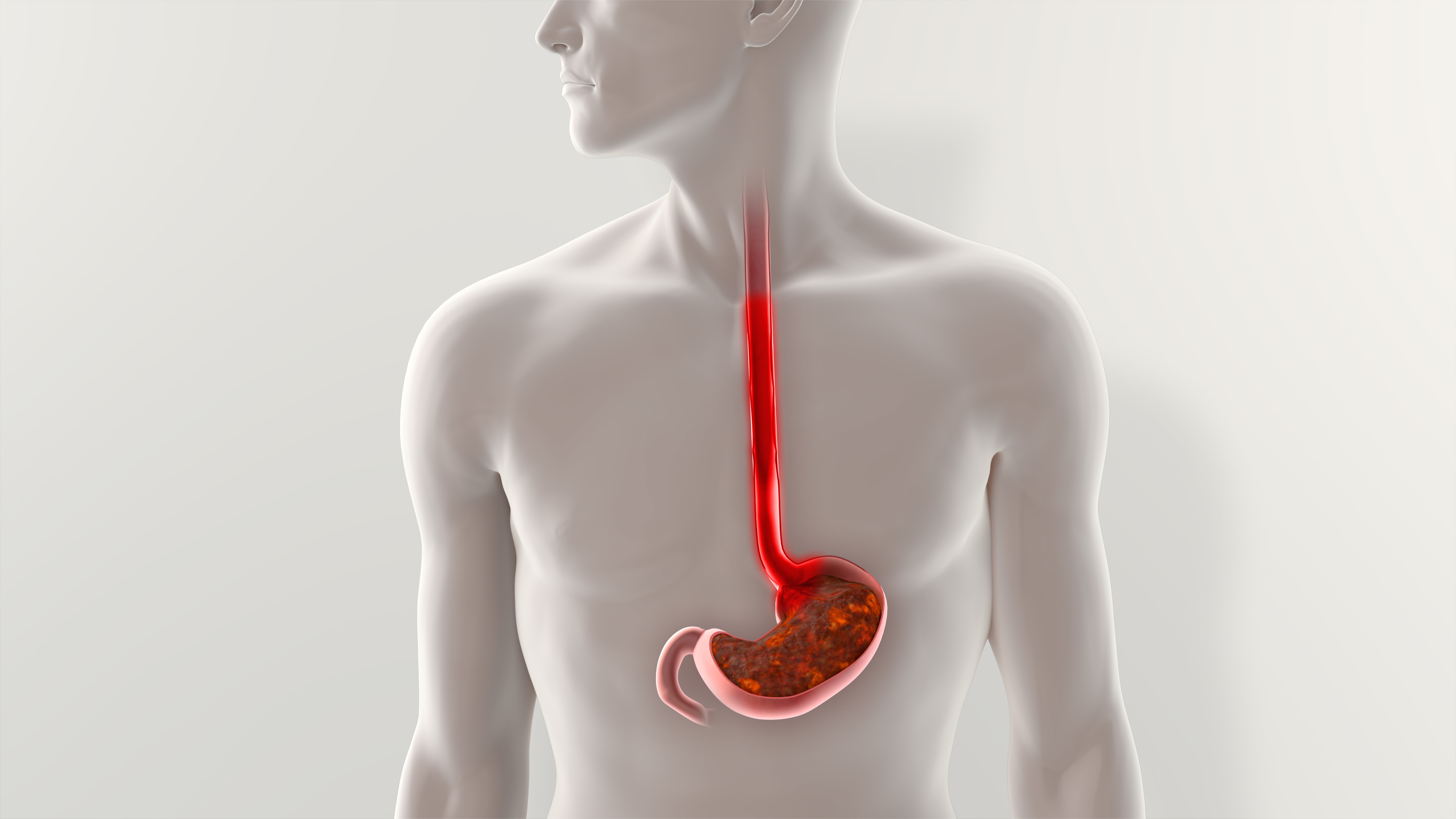 Getting to the Source of GERD with an Upper GI Endoscopy